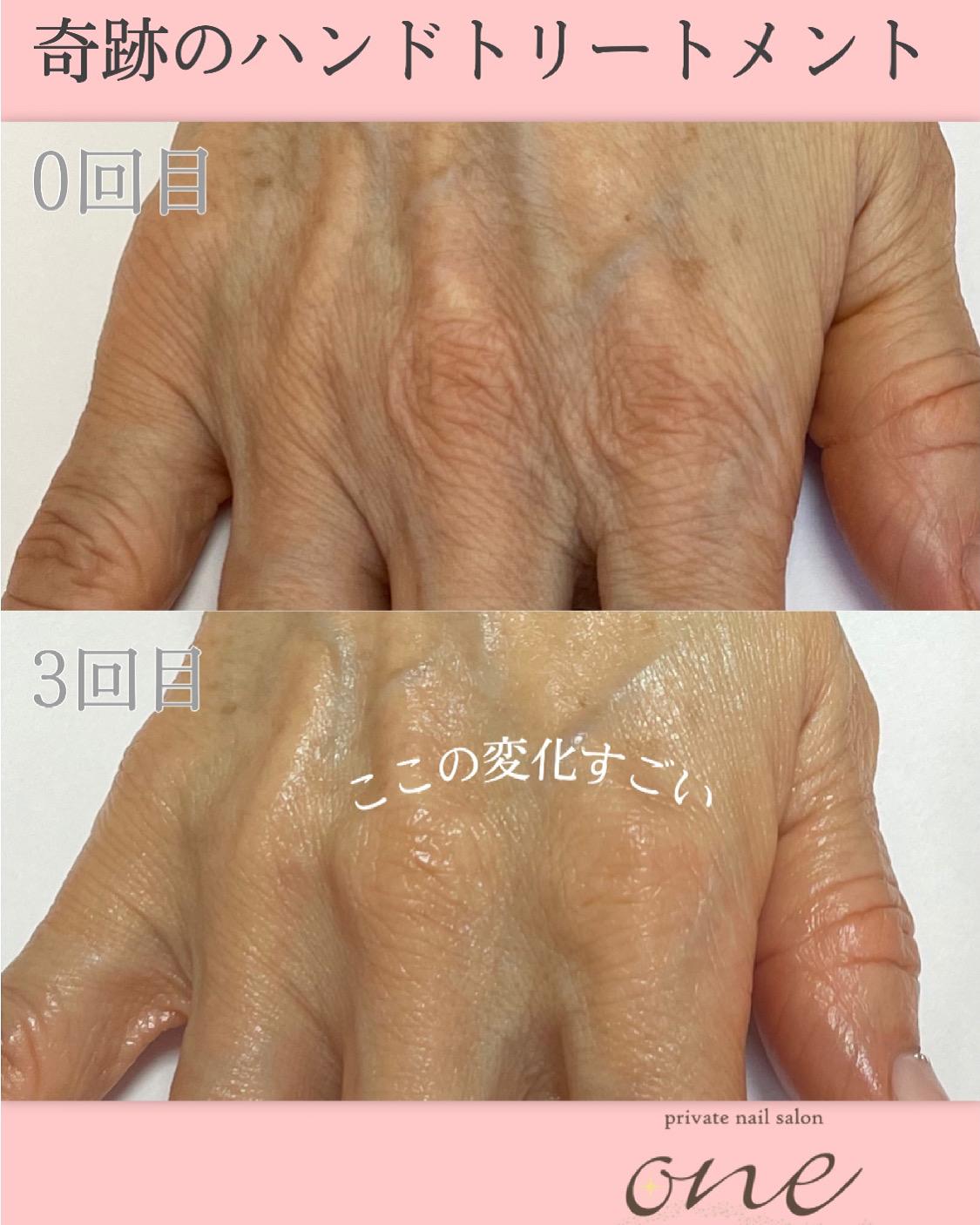 奇跡のハンドトリートメント